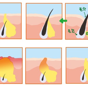 ＠cosmeニキビ特集